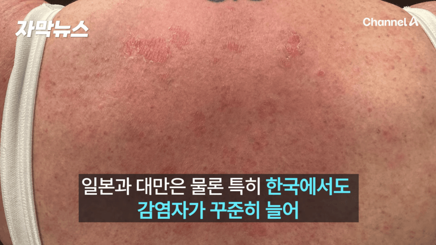 매독 감염자 확산, 한국 2030 남성 상당수(?) (3)