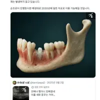 치아 재생 치료 성공