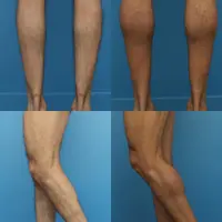 종아리가 잘 발달되지 않는다는 서양인들의 성형수술