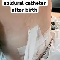 분만 후 등허리에서 무통주사 뽑는 장면