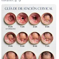 출산 중 자궁경부가 열리는 모습